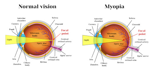 Nearsightedness (Myopia) Treatment Toronto | Clearview Vision